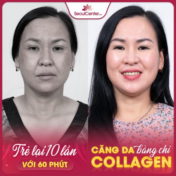 Top 5 địa chỉ căng chỉ collagen trẻ hóa da mặt uy tín tại Tp.HCM
